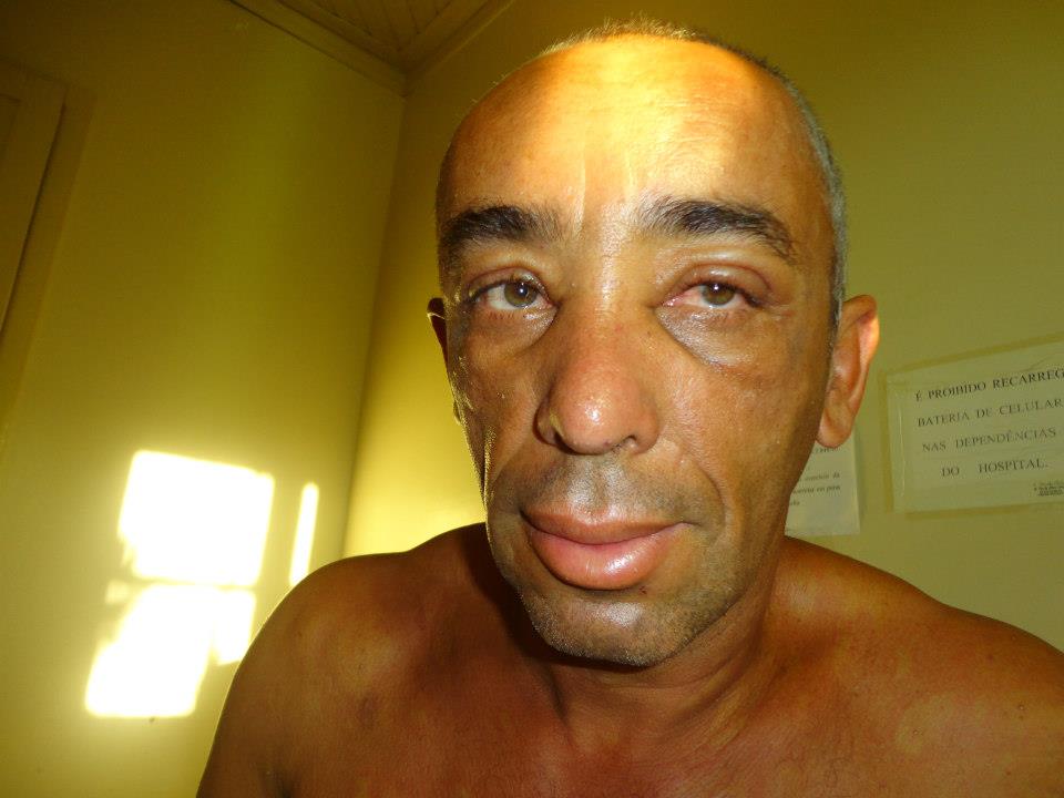Fiquei todo inchado devido as mais de mil ferroadas que levei