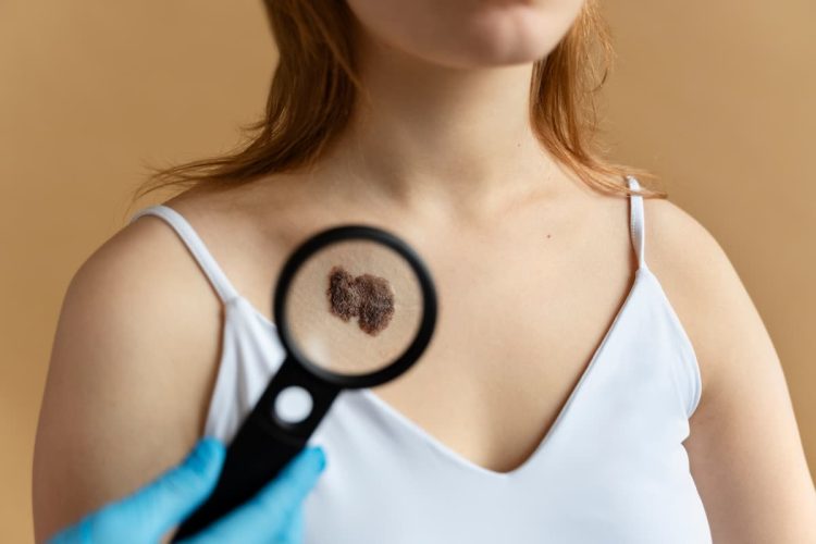 Dermatologista Stanley Bessa orienta como identificar sinais suspeitos de câncer de pele